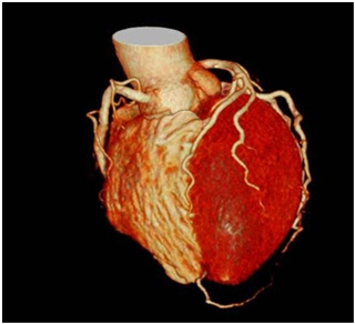 心臓血管３D画像