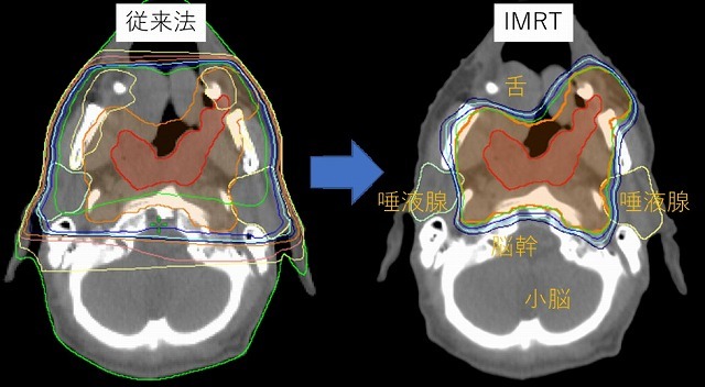 IMRTyuigaijisyou teigen.jpg