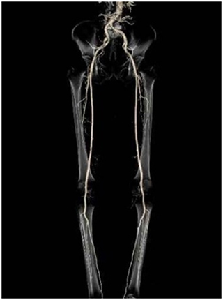 下肢血管3D画像