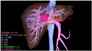 肝臓血管3D画像