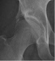 24歳、臼蓋形成術後2年レントゲン