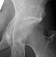 43歳、寛骨臼回転骨切術後2年レントゲン