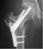 48歳、大腿骨頭前方回転骨切術後半年レントゲン