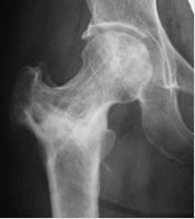 48歳、大腿骨頭前方回転骨切術後3年レントゲン