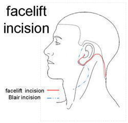 耳下腺腫瘍・側頚嚢胞手術1