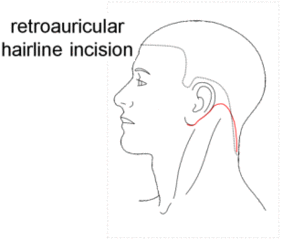 耳下腺腫瘍・側頚嚢胞手術2